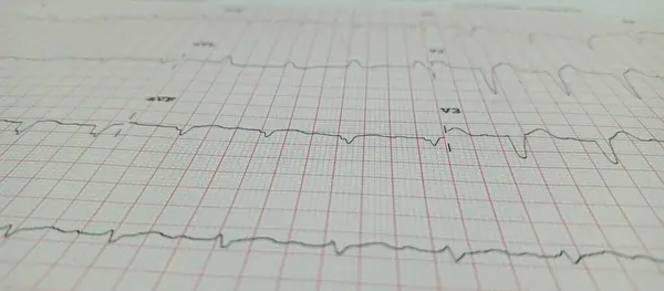 Standart bir şebeke kağıdında kalp ritmini gösteren elektrokardiyogramın (ECG) yakın çekimi. AVF ve V3 elektrokardiyogram uçlarında belirgin kardiyak aktivite ya da anormallikleri gösteren farklı dalga formları görülüyor..