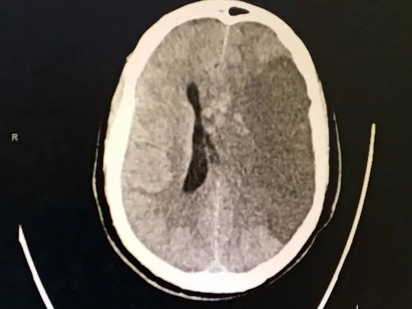 Beyin tomografisi orta hat kayması ile birlikte sağ tarafta büyük bir iç kanama olduğunu gösteriyor. Akut nörolojik acil durum ve kütle etkisini gösteriyor.
