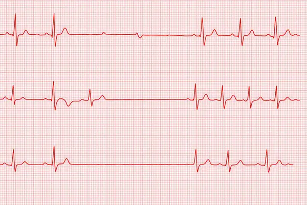 Standart kırmızı grafik kağıdındaki düzensiz kalp ritmini gösteren yüksek çözünürlüklü ecg dalgaboyu, kardiyoloji eğitimi, tanı ve sağlık hizmetleri görselleri için kullanışlı