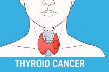 Tiroid bezini kırmızı ile işaretlenmiş kanserli gösteren eğitici tıbbi illüstrasyon, farkındalık, eğitim veya klinik kaynaklar için ideal mavi arka plan üzerine kuruludur.