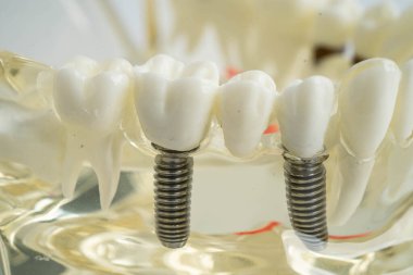 Diş implantı, çeneye yapay diş kökleri, diş tedavisinin kök kanalı, diş eti hastalığı, diş hekimliği üzerine çalışan dişçi modeli.