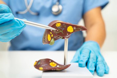 Dünya Hepatit Günü 'nde siroz, karaciğer kanseri, yağlı karaciğer, karaciğer anatomisi olan Asyalı doktor..
