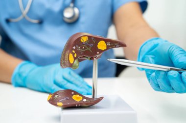 Dünya Hepatit Günü 'nde siroz, karaciğer kanseri, yağlı karaciğer, karaciğer anatomisi olan Asyalı doktor..