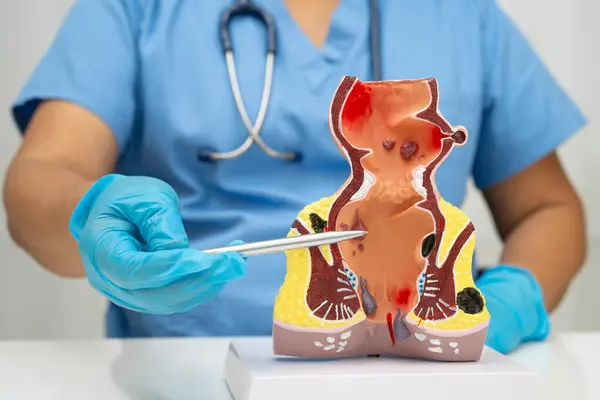 Hastanede rektum ve hemoroit insan anatomisi modeli olan Asyalı bir doktor vasküler yapısında iltihaplanma var..