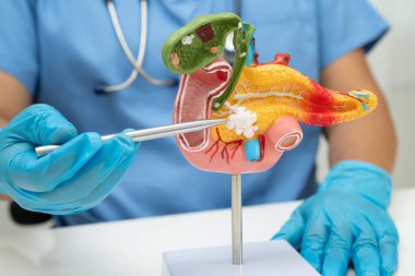 Pankreas iltihabı, pankreas hastası Asyalı doktor, safra kesesi ve safra kesesi insan anatomisi modeli..