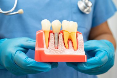 Diş implantı tutan diş hekimi, çeneye yapay diş kökleri, diş tedavisi kanal tedavisi, diş eti hastalığı, dişçi için diş modeli.