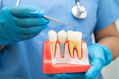 Diş implantı tutan diş hekimi, çeneye yapay diş kökleri, diş tedavisi kanal tedavisi, diş eti hastalığı, dişçi için diş modeli.