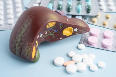 Hap tedavisi gören karaciğer modeli, siroz, karaciğer kanseri, yağlı karaciğer..