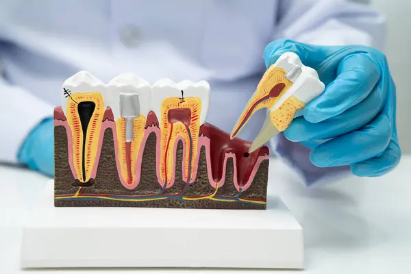 Diş implantı tutan diş hekimi, çeneye yapay diş kökleri, diş tedavisi kanal tedavisi, diş eti hastalığı, dişçi için diş modeli.