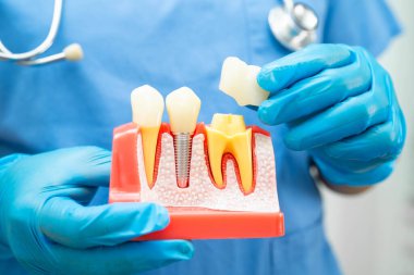 Diş implantı tutan diş hekimi, çeneye yapay diş kökleri, diş tedavisi kanal tedavisi, diş eti hastalığı, dişçi için diş modeli.