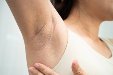 Asyalı kadınların siyah koltuk altı güzellik sorunları vardır..