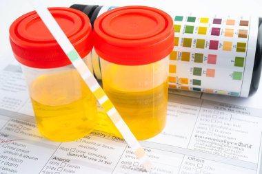 İdrar tahlili, reaksiyonlu idrar kabı. PH kağıt testi ve karşılaştırma tablosu laboratuvarda..