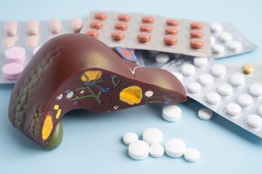 Hap tedavisi gören karaciğer modeli, siroz, karaciğer kanseri, yağlı karaciğer..