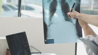 Doktor akciğerlerinin röntgen fotoğrafını gösteriyor.