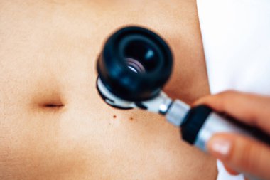 Modern dermatolojinin yakın çekim görüntülerini dijital deramatoskopla kontrol et. Dermoskopi mikroskop prosedürü ve cilt kanseri önleme tedavisi. 