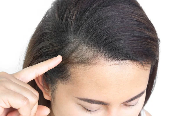 Zblízka Žena Ruční Držení Vypadávání Vlasů Problém Pro Zdravotní Péči — Stock fotografie