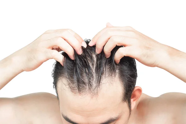 Closeup Young Man Serious Hair Loss Problem White Backgroun Health — Stock Photo, Image