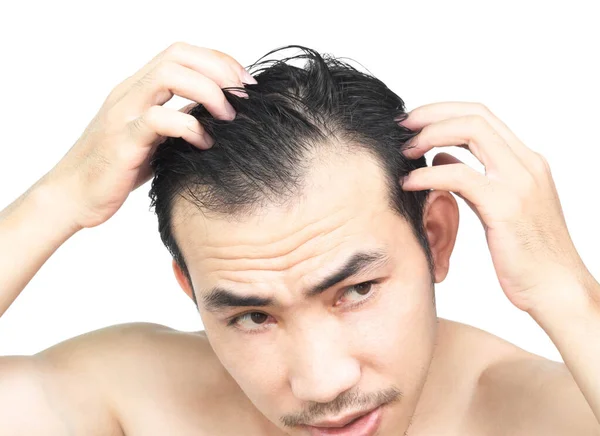閉じる若い男の深刻な脱毛の問題は 医療やシャンプー製品のコンセプト 選択的な焦点のための白い背景と — ストック写真