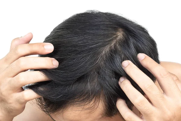 Penutup Pria Muda Yang Kehilangan Rambut Serius Masalah Dengan Backgroun — Stok Foto