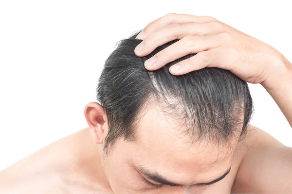 Detailní Záběr Mladý Muž Vážné Vypadávání Vlasů Problém Bílým Backgroun — Stock fotografie