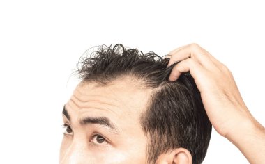 Sağlık hizmetleri tıbbi ve şampuan ürünleri konsepti için beyaz bir grupla ciddi saç kaybı sorunu yaşayan genç adam.