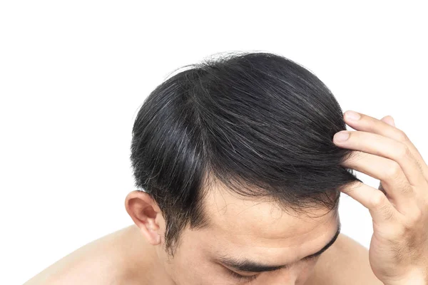 Closeup Young Man Serious Hair Loss Problem Gray Hair White — Stock Photo, Image