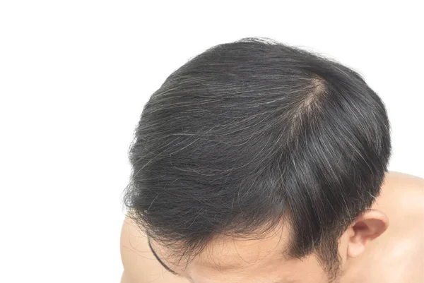 Nahaufnahme Junger Mann Ernstes Problem Mit Haarausfall Graue Haare Mit — Stockfoto