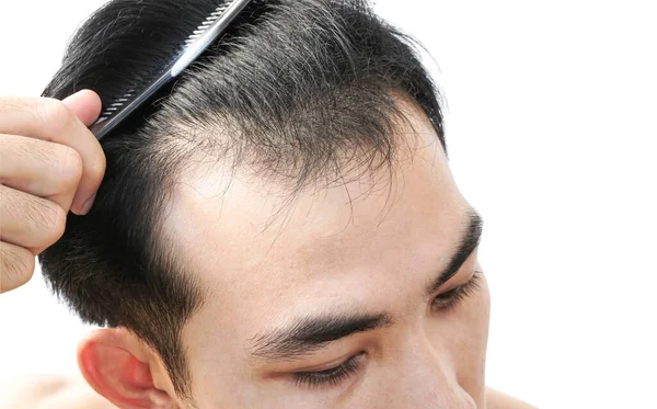 Closeup Young Man Serious Hair Loss Problem White Backgroun Health Stock Image