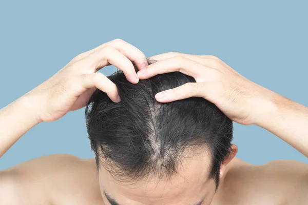 Detailní Záběr Mladý Muž Vážné Vypadávání Vlasů Problém Modrým Backgroun — Stock fotografie