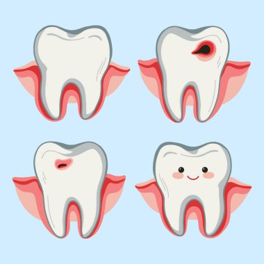 Sağlıklı ve çürümüş aşamaları gösteren sevimli diş çizimleri. Çocuk dişçiliği, posterler ve oral sağlık malzemeleri için eğitim ve tıbbi diş konsepti.