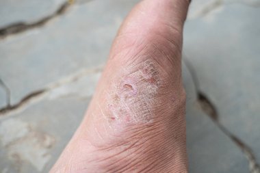 Ayaklarının tabanında kaşıntı olan bir adamın yakın plan fotoğrafını çek.