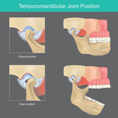 Temporomandibular eklem pozisyonu. Ağzını açtığında, çene kemiğini kafatasına bağlayan kaygan bir menteşe gibi hareket eder.