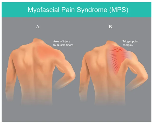 トリガーポイント疼痛症候群 人間の肩の領域の背部慢性疼痛障害 イラスト情報 — ストックベクタ