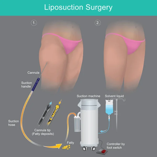 抽脂手术 解释在大腿区域实施抽脂手术的方法 — 图库矢量图片