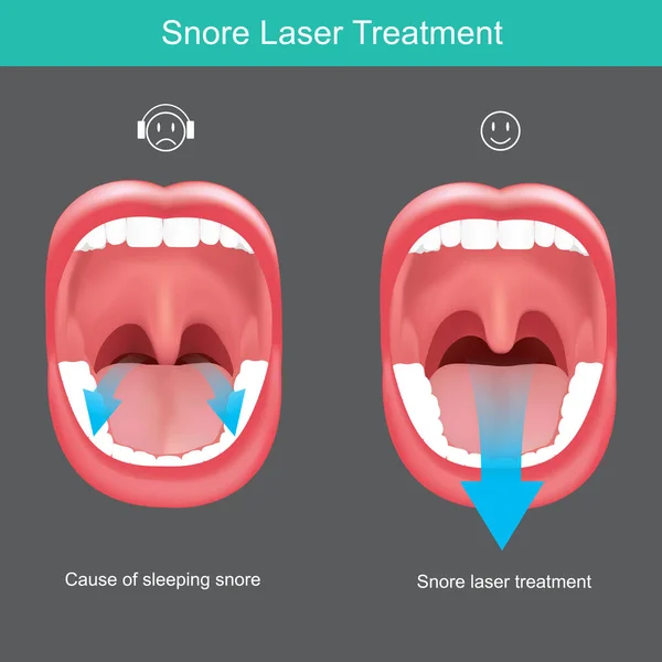 Snore Laser Treatment Oral Cavity Picture Explain Cause Sleeping Snore — Stock Vector