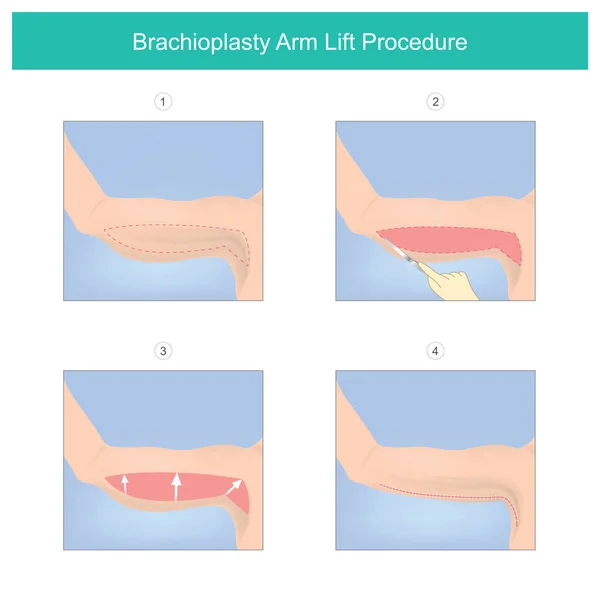 Procedimiento Levantamiento Brazos Con Braquioplastia Proceso Médico Exceso Piel Grasa — Vector de stock