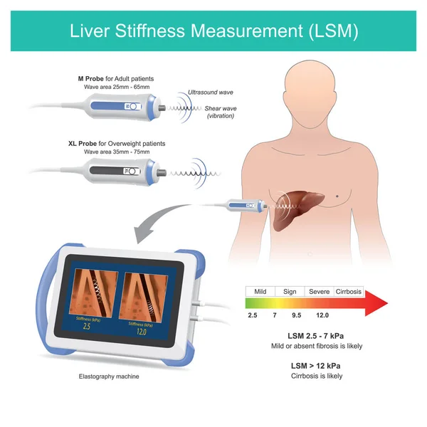 肝脏硬度测量 应用反射声波测量肝硬化患者的组织肝刚度 — 图库矢量图片