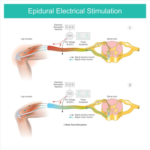 Epidurale Elektrische Stimulation Muskelschmerzen Symptom Beinbereich Und Behandlung Durch Elektrische — Stockvektor