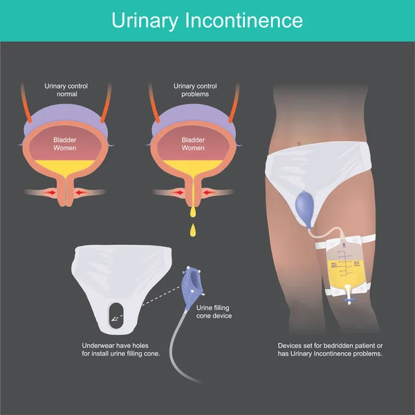 Incontinência Urinária Dispositivo Cone Enchimento Urina Para Pacientes Acamados Com — Vetor de Stock