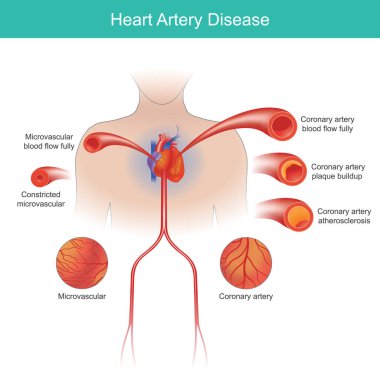 Kalp atardamarı hastalığı. Kalbe giden kan akışının azalması göğüs ağrısına ve nefes darlığına neden olabilir..