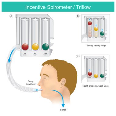 Spirometreyi teşvik et. Triflow Akciğer Egzersiz Aygıtı Illustratio