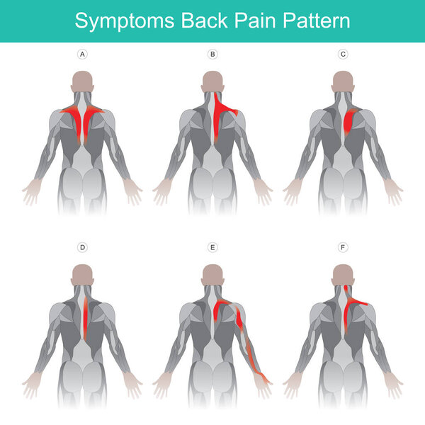 Серия анатомических диаграмм, иллюстрирующих различные общие закономерности боли в спине и боли в верхней части спины, плечах и руках человека