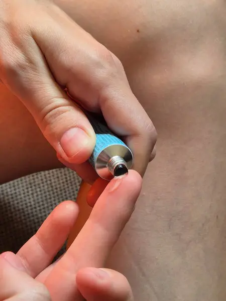 Bacaklardaki örümcek damarları için krem. Kadın vücuduna krem sürüyor. Bacağında krema var. Ellerinde merhem tüpü var. Damarlarda sorun var