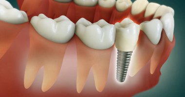 Daha iyi anlamak için seramik diş implantına daha yakından bakın. Tıbbi olarak onaylanmış..