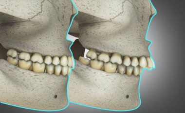 Üst dişler veya iskelet sınıfı 2. Malocclusion, öncesi ve sonrası..