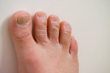 Ayak parmaklarında ölü deri, ayak parmaklarında mantar hastalığı var.,