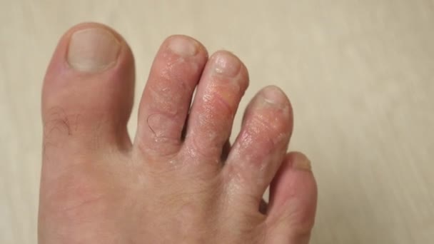 Очищающий Крем Наносился Мозолистые Пальцы Ног Пальцы Ног Грибком Имели — стоковое видео