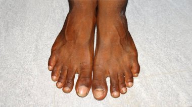İnsan ayağının gözle görülür hasarlı ayak tırnaklarıyla detaylı bir yakın çekimi. Ayak tırnakları soluk ve çatlamış görünüyor, muhtemelen sağlık sorunları ya da yaralanmaları var. Ayakları açık bir yüzeyde duruyor, doğal dokular sergiliyor..