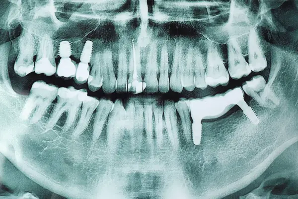 Çeneli insan dişlerinin x-ray resmi