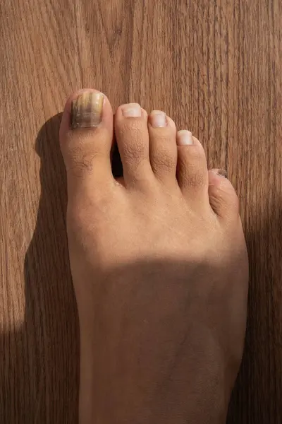 Mantar enfeksiyonunun yol açtığı rengarenk ayak tırnağı zedelenmiş bir ayak makro çekimi. Sağlık, ayak hastalıkları ve tıbbi görseller için kullanışlı.